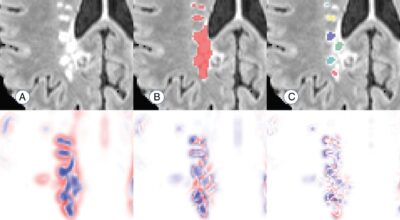 An Automated Statistical Technique for Counting Distinct Multiple Sclerosis Lesions Image