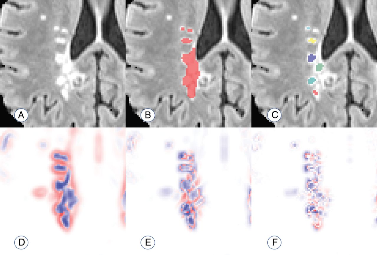 An Automated Statistical Technique for Counting Distinct Multiple Sclerosis Lesions Image