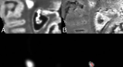 Automated Integration of Multimodal MRI for the Probabilistic Detection of the Central Vein Sign in White Matter Lesions Image