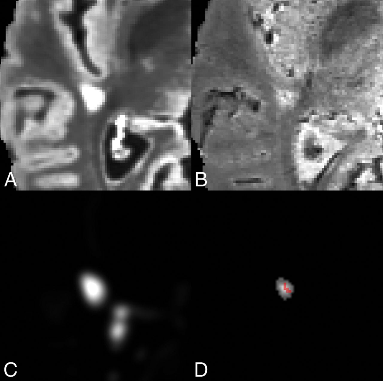 Automated Integration of Multimodal MRI for the Probabilistic Detection of the Central Vein Sign in White Matter Lesions Image