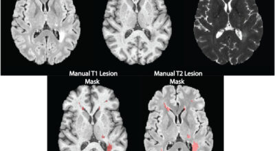 Detecting Black Holes in Multiple Sclerosis Image