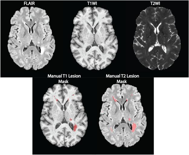 Detecting Black Holes in Multiple Sclerosis Image