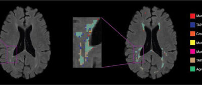 Automatic Threshold Detection for Classification of Lesions Image