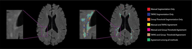 Automatic Threshold Detection for Classification of Lesions Image