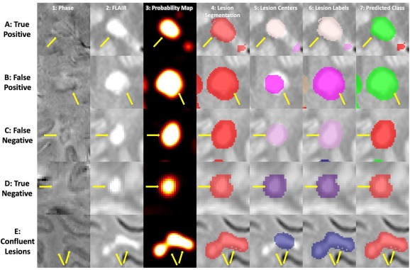 Fully Automated Detection of Paramagnetic Rims in Multiple Sclerosis Lesions on 3T Susceptibility-Based MR Imaging Image