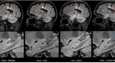 Volumetric Analysis from a Harmonized Multisite Brain MRI Study of a Single Subject with Multiple Sclerosis Image