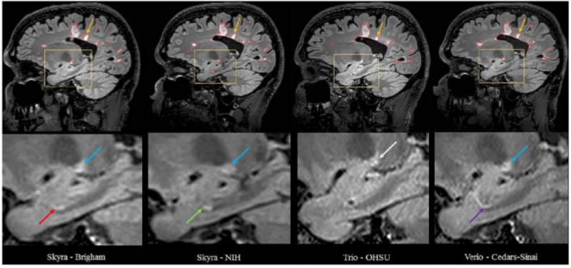 Volumetric Analysis from a Harmonized Multisite Brain MRI Study of a Single Subject with Multiple Sclerosis Image