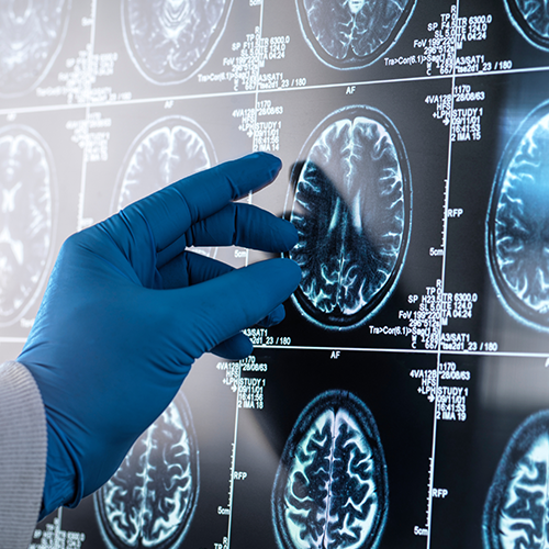 MRI image of a brain with a gloved hand pointing to an area of interest.