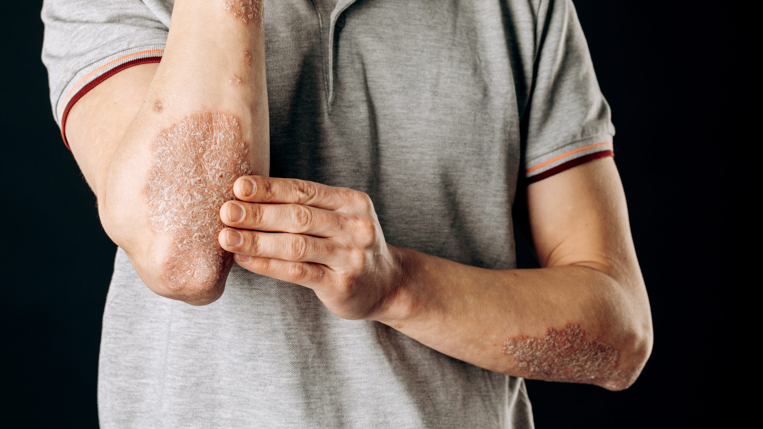 What Matters Most: Treatment Goals from the Perspective of People Living with Psoriatic Arthritis Image